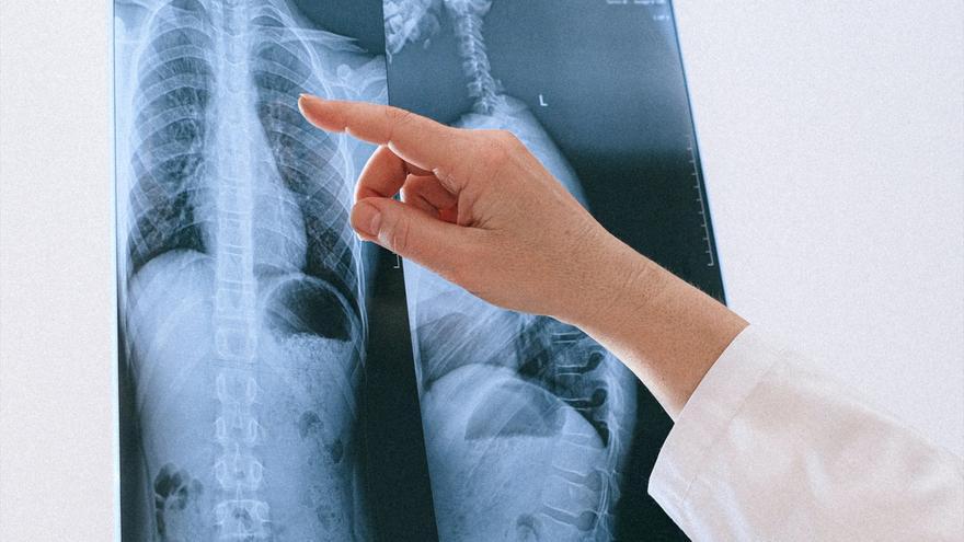 Los oncólogos advierten que el cáncer de pulmón está aumentando entre los no fumadores