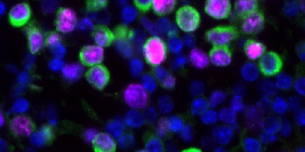 El frío o la gripe son células cancerosas ocultas en los pulmones
